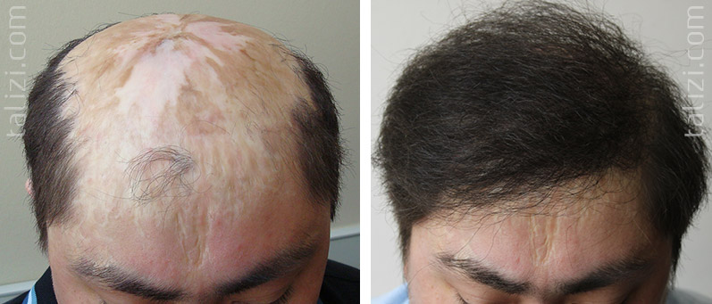 Hair Transplantation Fue Long Hair Transplant