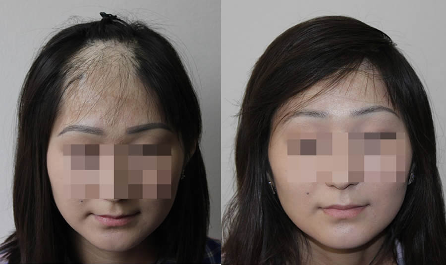 Female Hair Transplants. Before & After