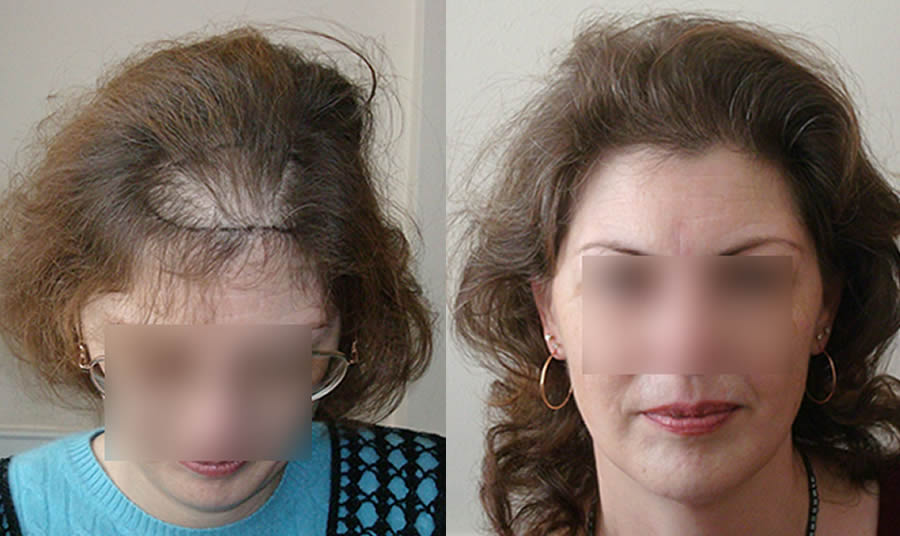 Female Hair Transplants. Before & After